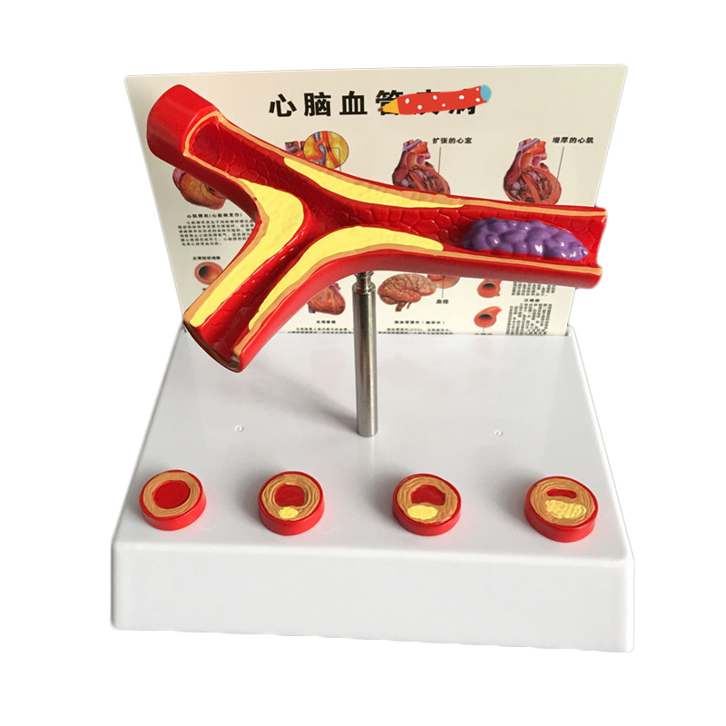 Medical Lab And Science - 50-krotne powiększone ludzkie naczynie Atherosclerosis Model